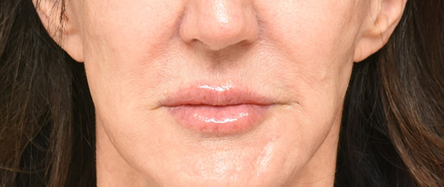 Lip Lift Patient 17 Set 1 Before
